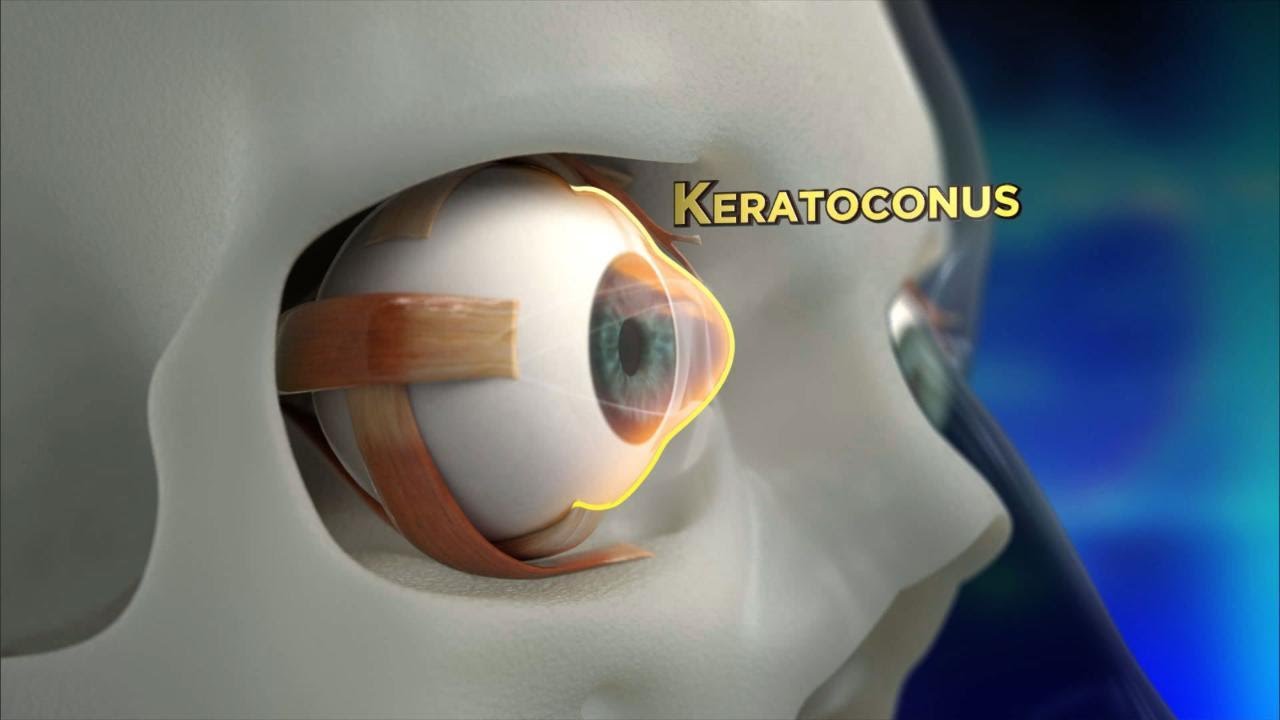 Keratoconus Treatment in Muzaffarnagar