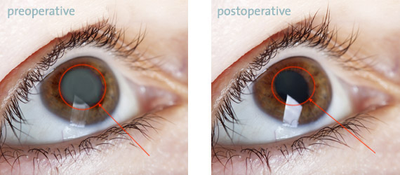 Cataract Surgery In Muzaffarnagar | Pre Operative cataract eye - Post Operative Cataract Eye