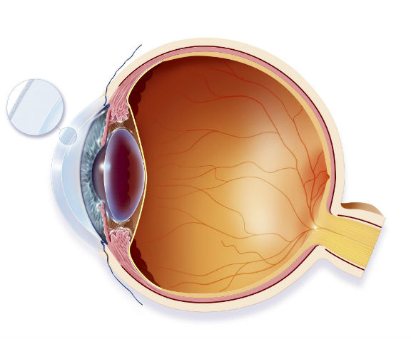 Cataract Surgery in Muzaffarnagar best eye hospital in Muzaffarnagar - Paras Netralaya