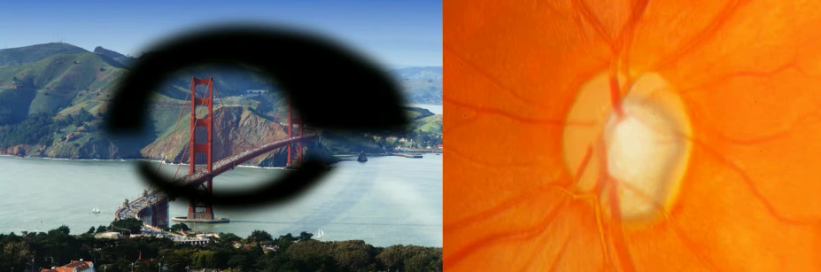 Glaucoma Treatment In Muzaffarnagar - Paras Netralaya