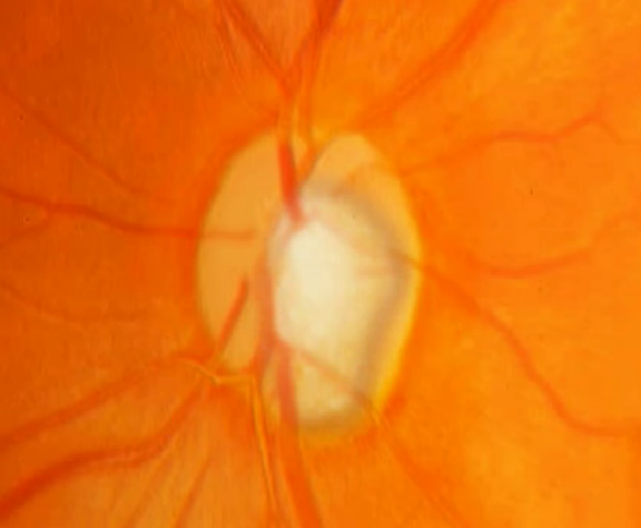 Glaucoma Services in Muzaffarnagar - best eye hospital in Muzaffarnagar - Paras Netralaya