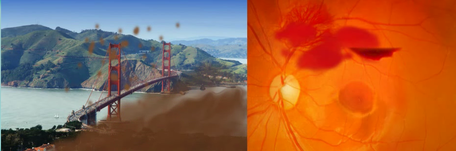 Diabetic Retinopathy Treatment - Paras Netralaya