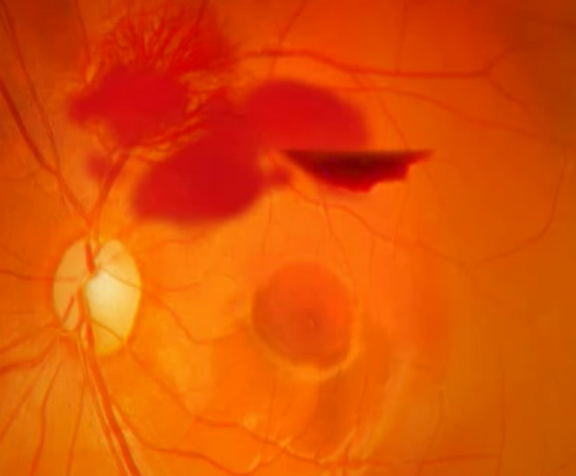 Medical retina services in jalandhar - best eye hospital in jalandhar - Pal hospital eyetec clinics & the children centre