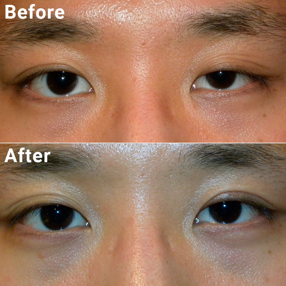 Ptosis Treatment at Paras Netralaya